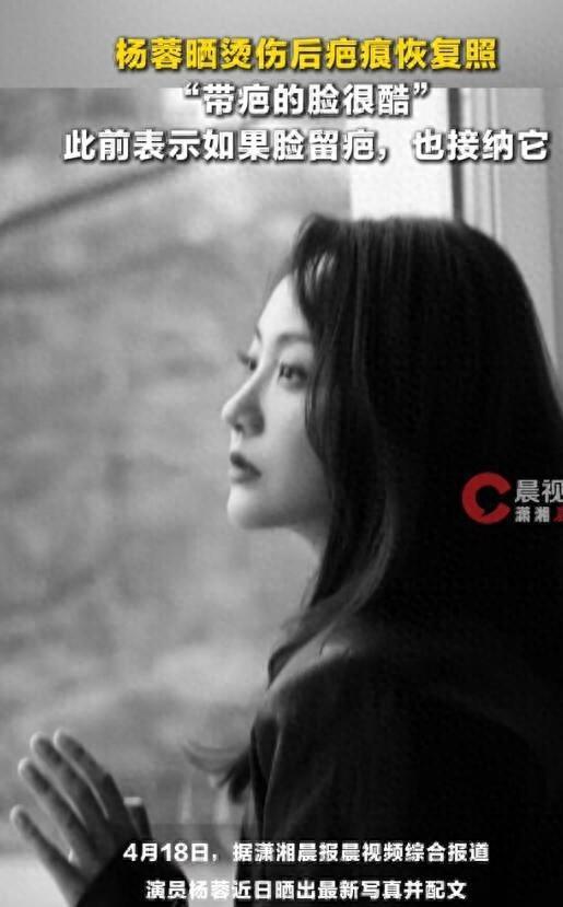 配资优秀炒股配资门户 演员杨蓉晒烫伤后疤痕恢复照，称“带疤的脸很酷”